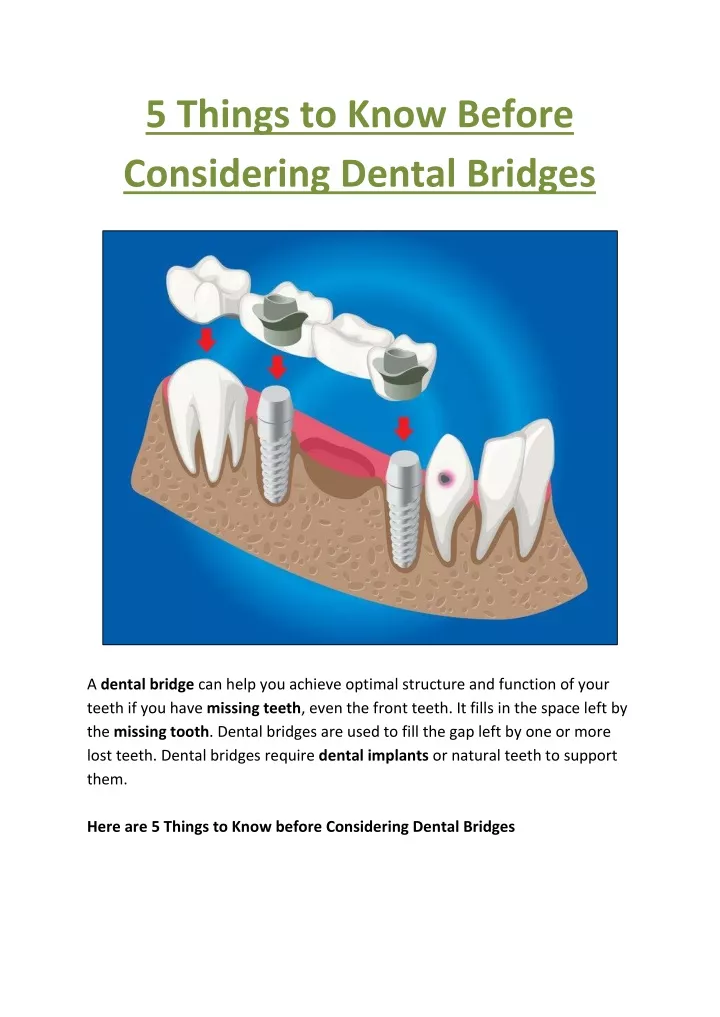 5 things to know before considering dental bridges