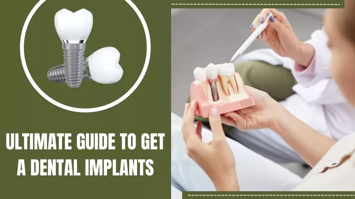 ultimate guide to get a dental implants