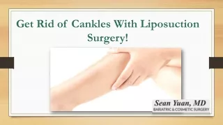 get rid of cankles with liposuction surgery