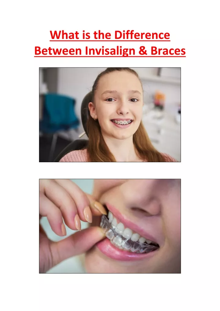 what is the difference between invisalign braces