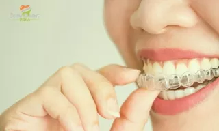 Invisible Teeth Braces On Cosmodent India