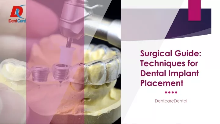 surgical guide techniques for dental implant placement