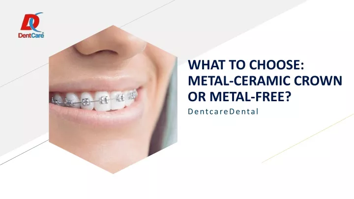 what to choose metal ceramic crown or metal free