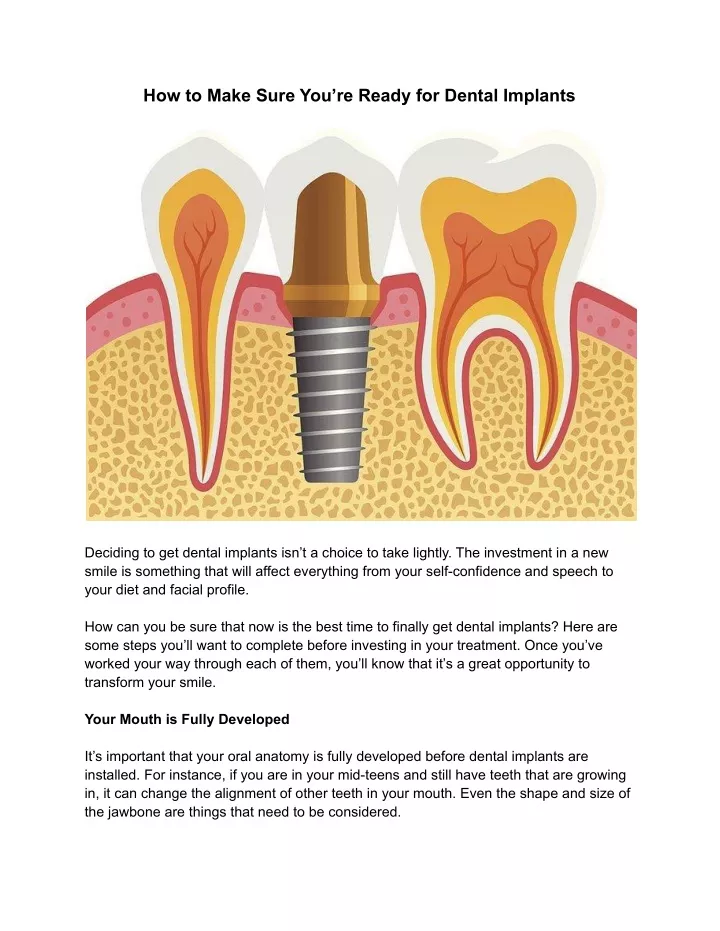 how to make sure you re ready for dental implants