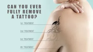 Can You Ever Fully Remove A Tattoo?