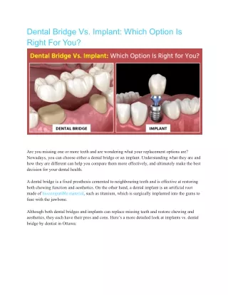 Dental Bridges Vs. Dental implant Which One is Best for You?