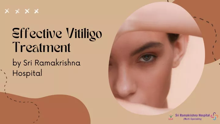 effective vitiligo treatment by sri ramakrishna