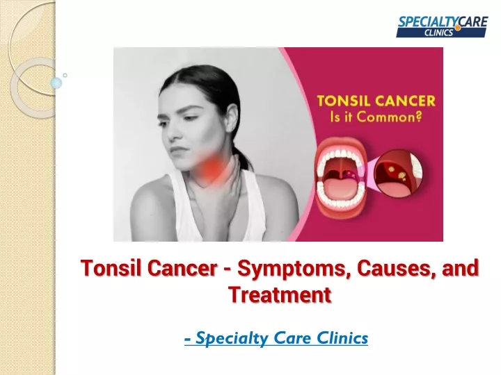 Tonsil Cancer Symptoms Causes And Treatment N 