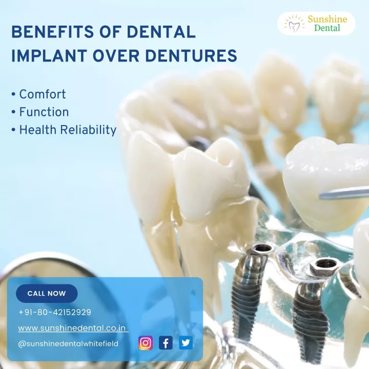 benefits of dental implant over dentures