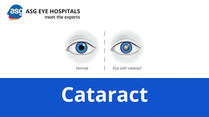 PPT - Cataract PPT PowerPoint Presentation, free download - ID:11216478