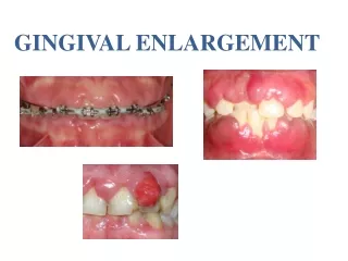 gingival enlargement
