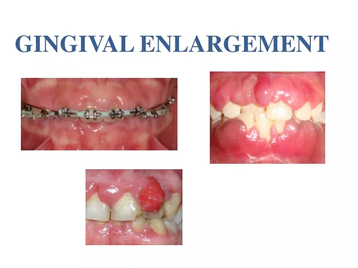 gingival enlargement