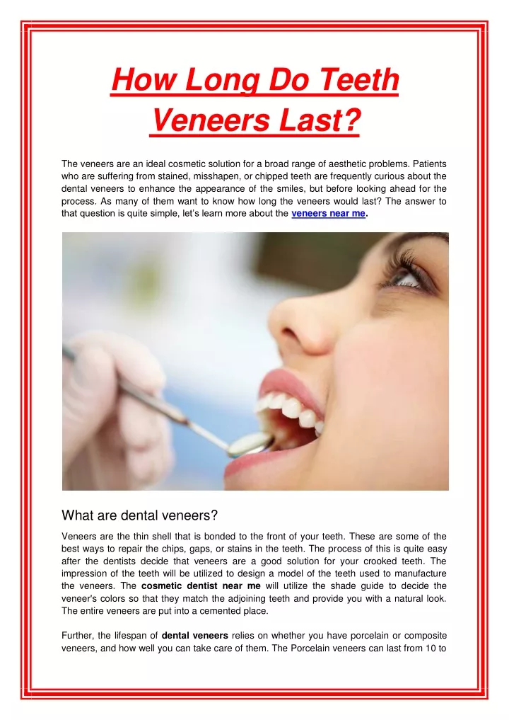 how long do teeth veneers last