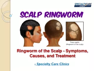 ringworm of the scalp symptoms causes and treatment