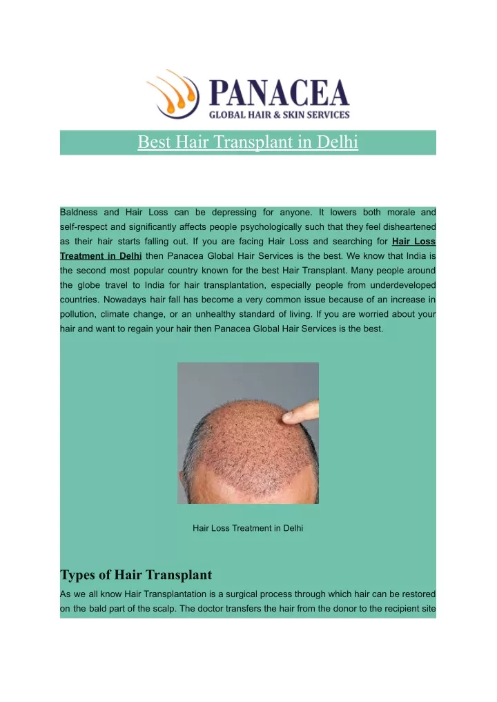 best hair transplant in delhi