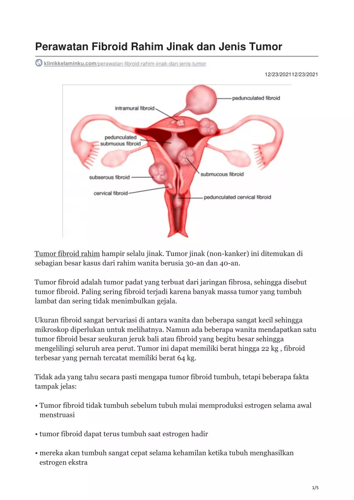 perawatan fibroid rahim jinak dan jenis tumor
