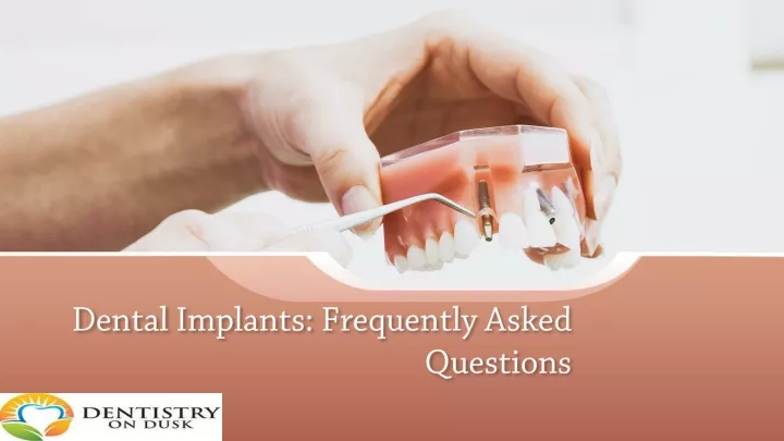 dental implants frequently asked questions