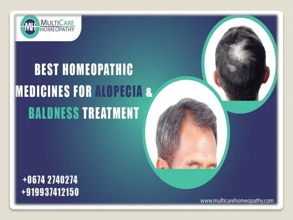 Best Homeopathic Medicine for ALOPECIA & BALDNESS Treatment- Multicare Homeopath