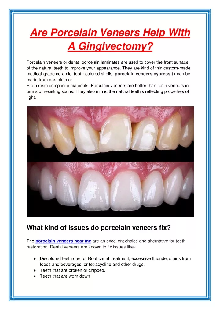 are porcelain veneers help with a gingivectomy