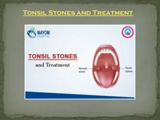 Tonsil Stones and Treatment | ENT Treatment in Gurgaon