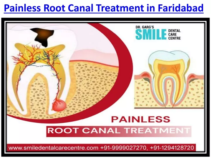 painless root canal treatment in faridabad