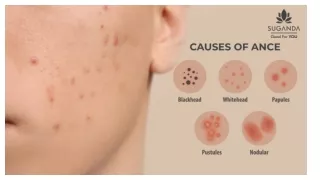5 TYPES OF ACNE YOU SHOULD KNOW ABOUT