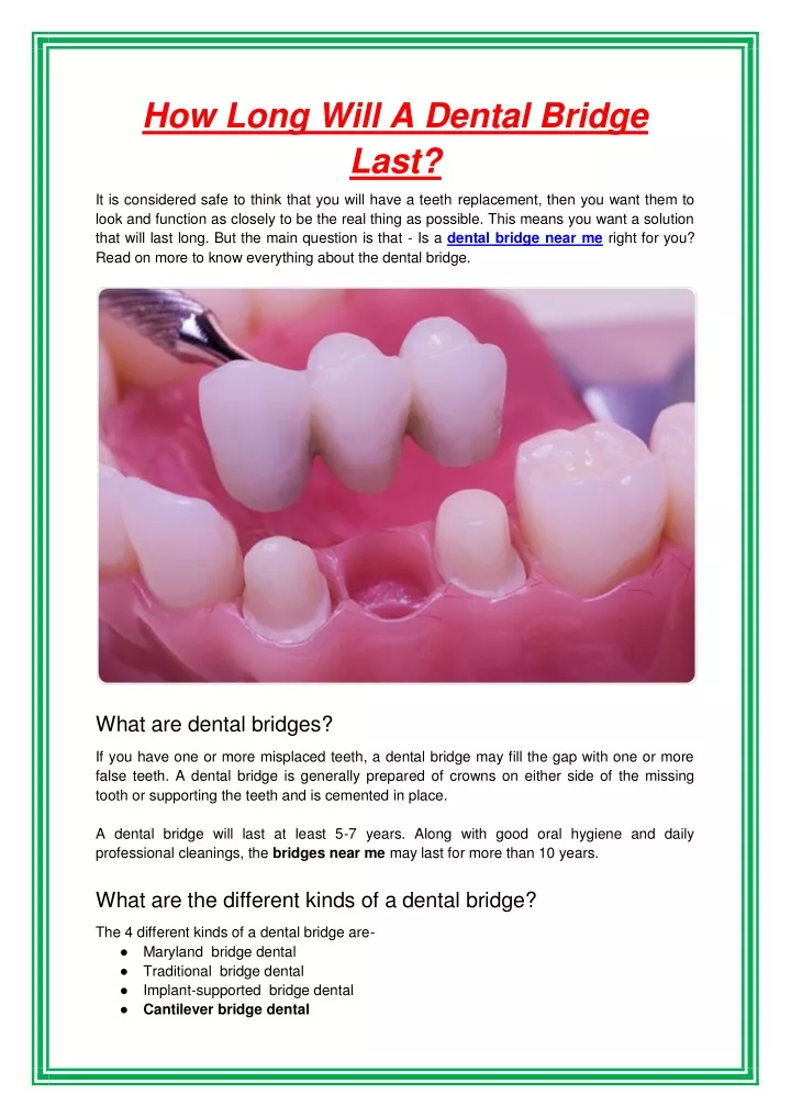 how long will a dental bridge last