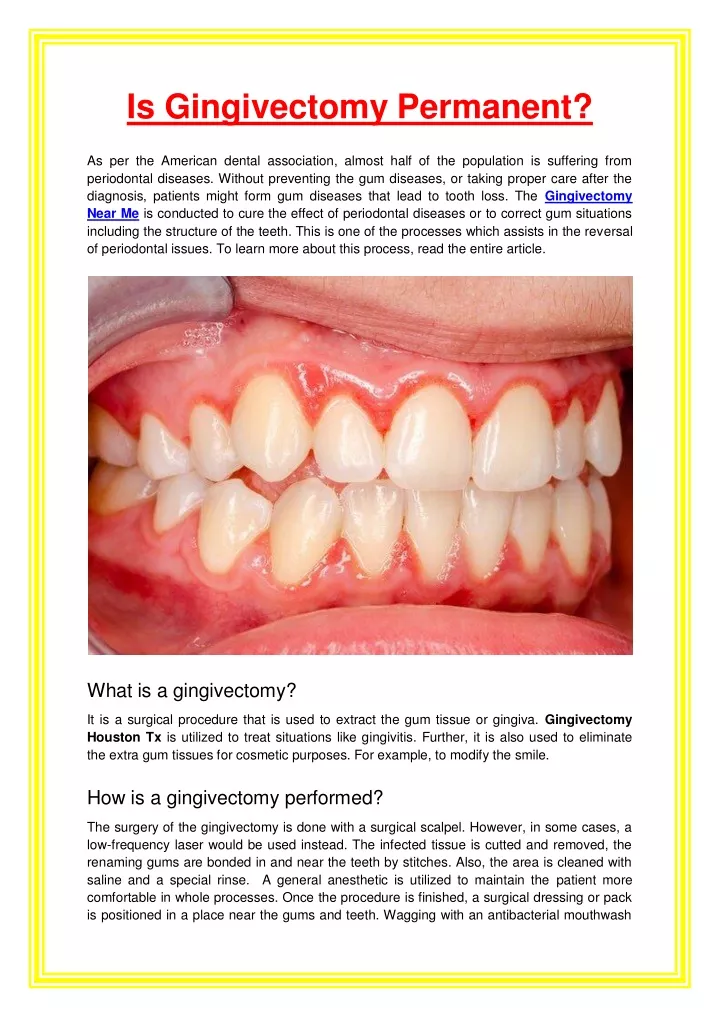is gingivectomy permanent