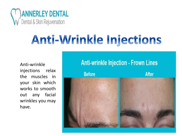 anti wrinkle injections