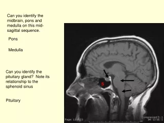 Can you identify the pituitary gland?  Note its relationship to the sphenoid sinus