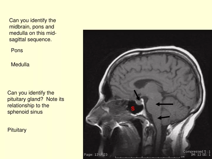 can you identify the midbrain pons and medulla
