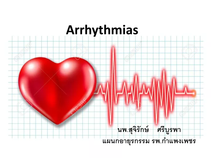 arrhythmias
