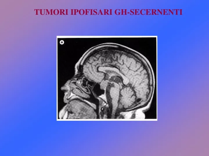 tumori ipofisari gh secernenti
