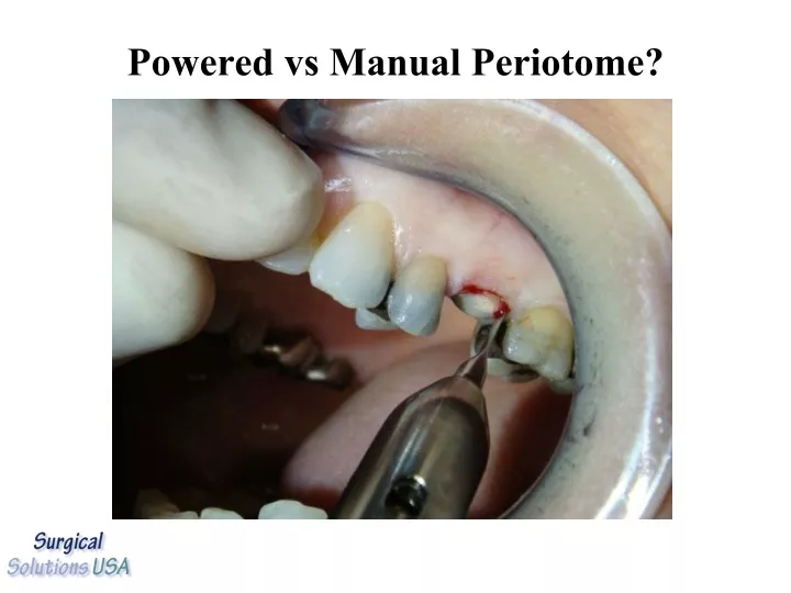 powered vs manual periotome