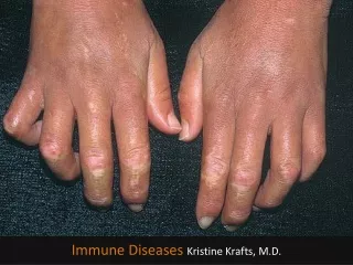 Immune Diseases  Kristine Krafts, M.D.