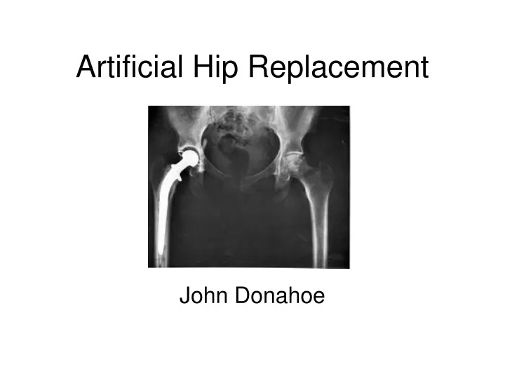 artificial hip replacement