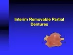 Interim Removable Partial Dentures