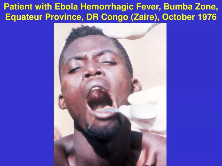 patient with ebola hemorrhagic fever bumba zone
