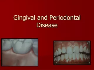 Gingival and Periodontal Disease