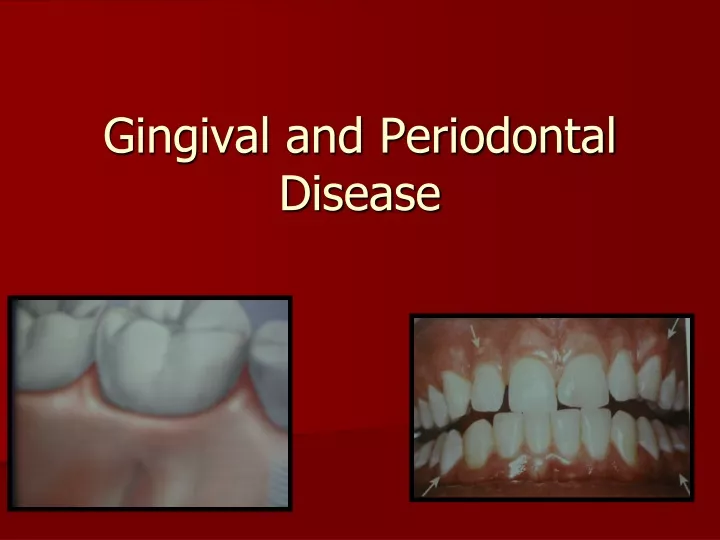 gingival and periodontal disease