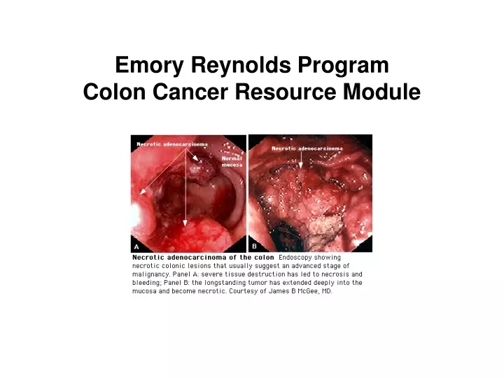 emory reynolds program colon cancer resource module