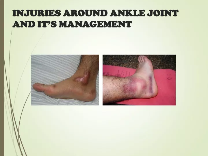 injuries around ankle joint and it s management