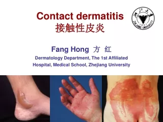 Contact dermatitis 接触性皮炎