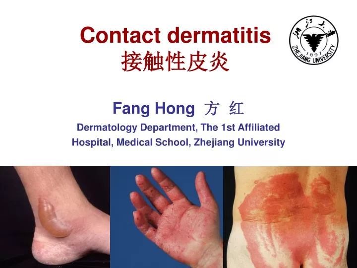 contact dermatitis