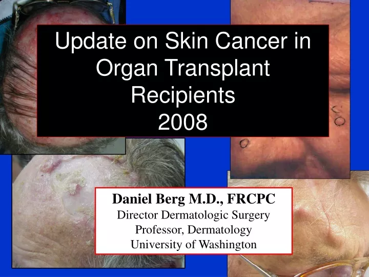 update on skin cancer in organ transplant