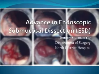 Advance in Endoscopic Submucosal Dissection (ESD)