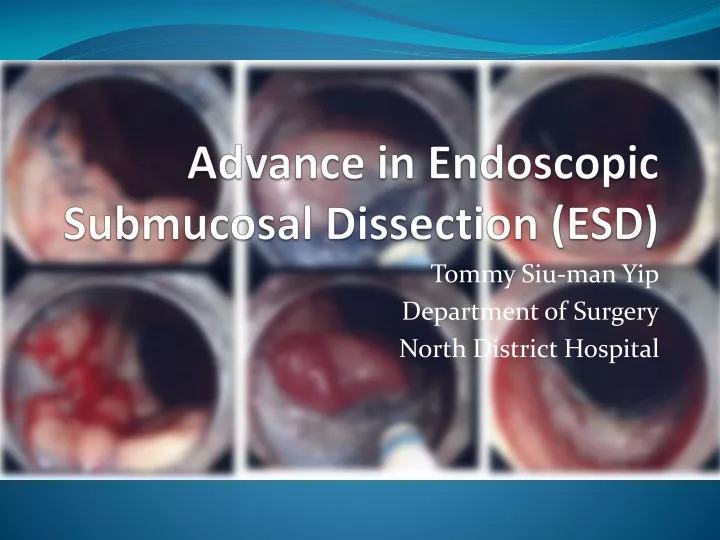 advance in endoscopic submucosal dissection esd