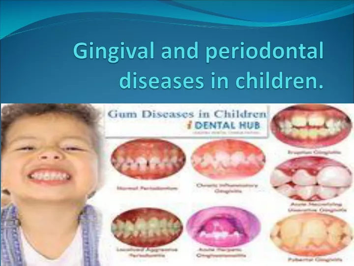 gingival and periodontal diseases in children