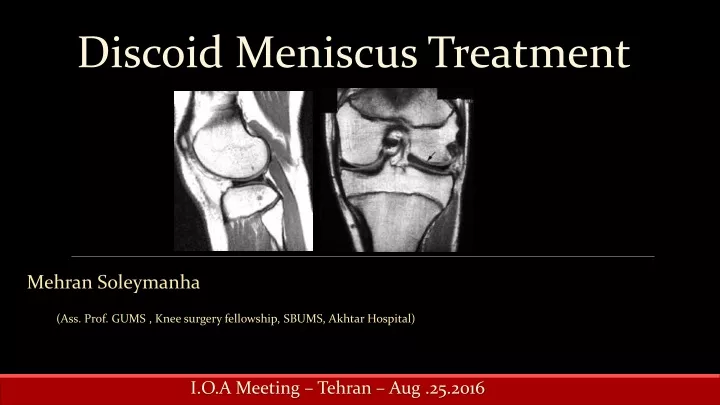 discoid meniscus treatment