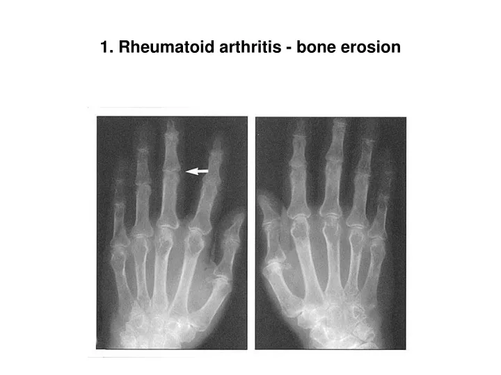 1 rheumatoid arthritis bone erosion